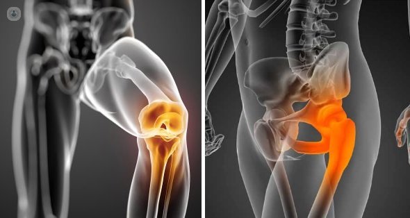 Artrosis de cadera y rodilla