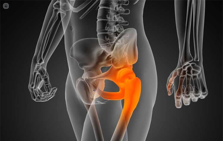 Qué causa el dolor de cadera? | Top Doctors