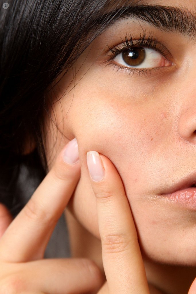 Curiosidades sobre el acné | Dermatólogo - Bilbao