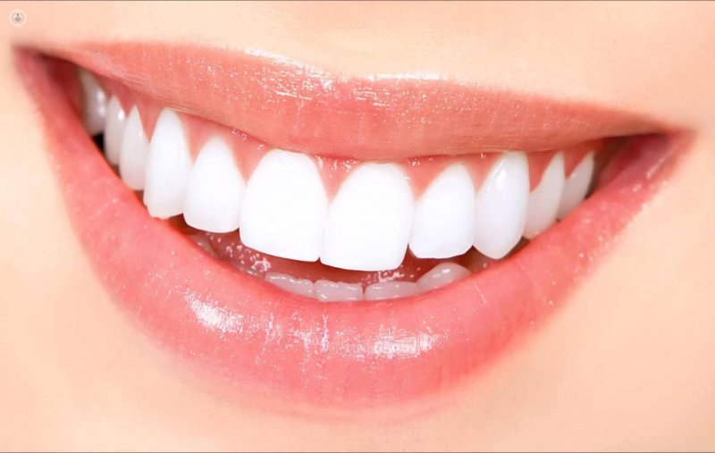 ventajas de las carillas dentales