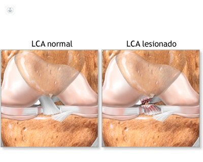 rotura del ligamento cruzado anterior - DR BALLESTER- TRAUMATOLOGIA CIRUGIA  ORTOPEDICA