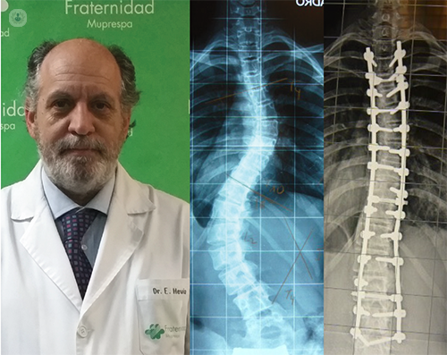 Evolución de las técnicas de cirugía de columna vertebral