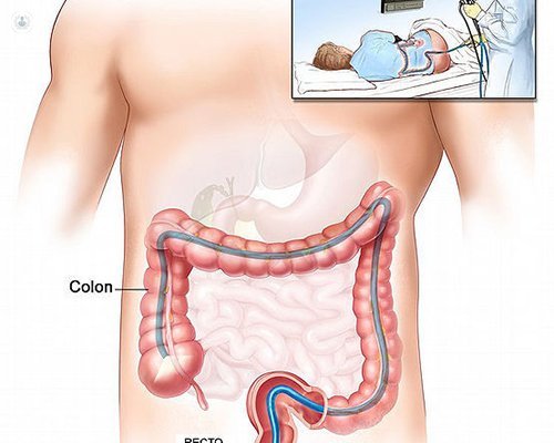 Cómo se realizan la gastroscopia y la colonoscopia | Top Doctors