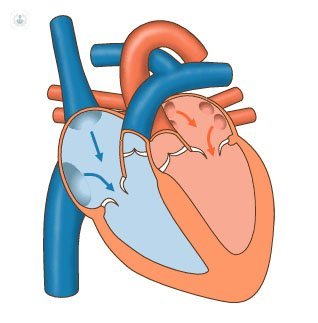 Soplos en el corazón: causas y tratamiento | Top Doctors