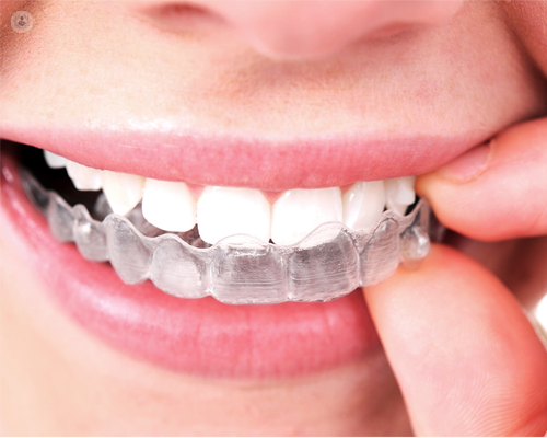 Ventajas y resultados de la ortodoncia invisible