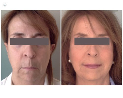 Técnicas de rejuvenecimiento facial