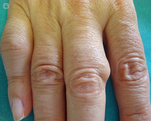 Artritis reumatoide: síntomas, causas, diagnóstico y tratamiento