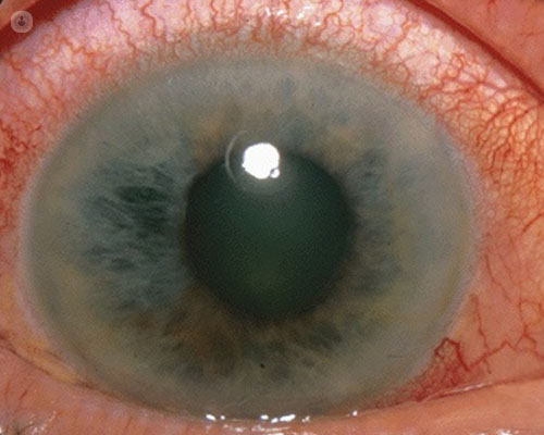 Cómo tratar un glaucoma