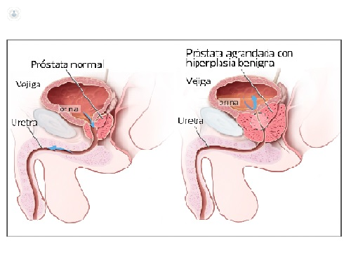Láser prostático y su uso para el adenoma de próstata