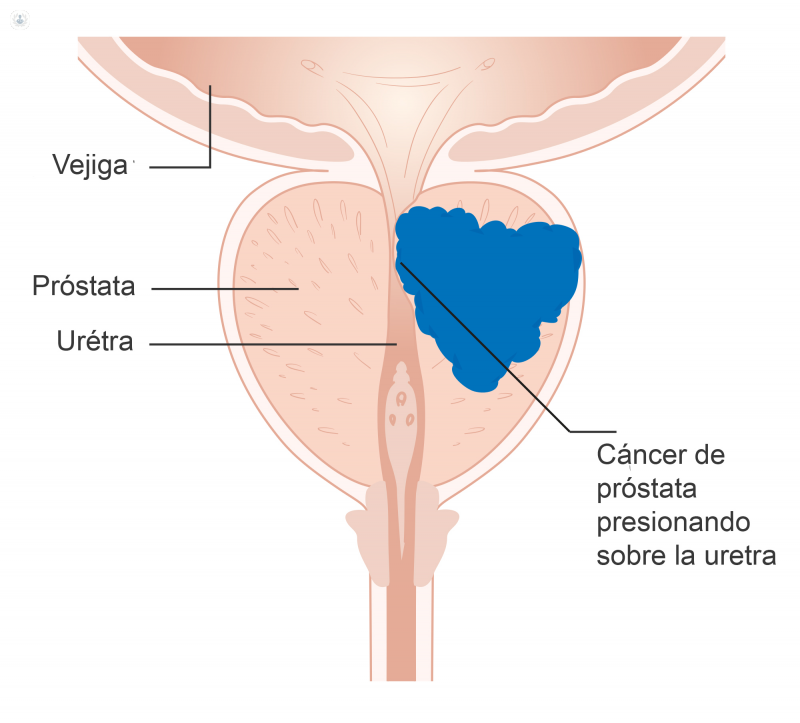 Pacientes con cáncer de próstata se beneficiarán de la cirugía