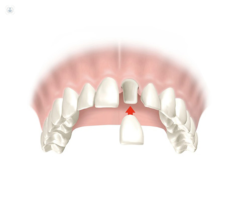 Corona dental: qué es, síntomas y tratamiento | Top Doctors