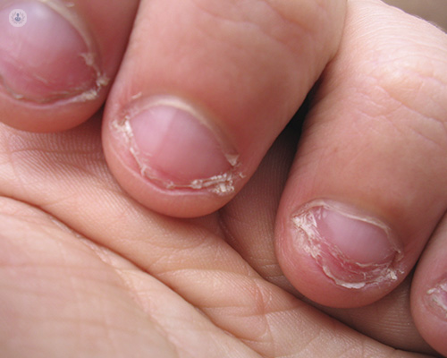 Enfermedades de las uñas: qué es, síntomas y tratamiento | Top Doctors