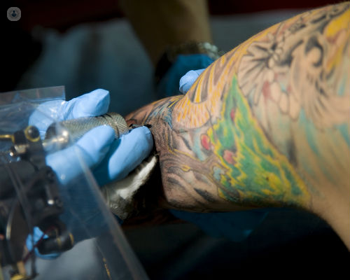 Sesiones necesarias para eliminar tatuajes con láser