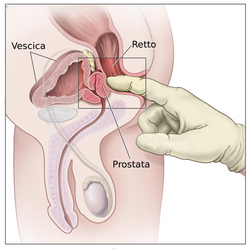 Biopsia de próstata: ventajas e inconvenientes del PSA