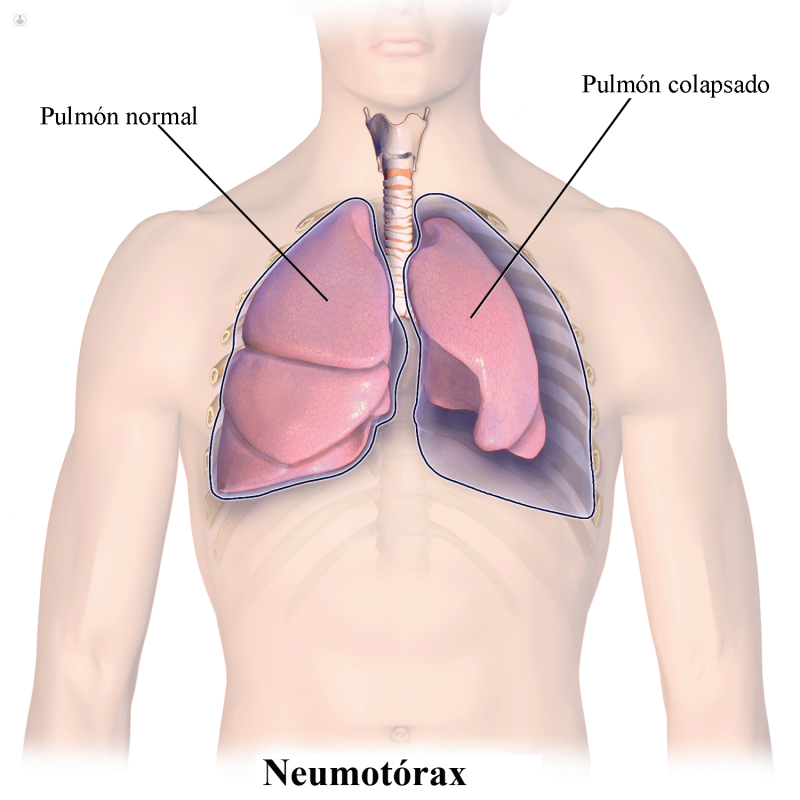Neumotórax: qué es, síntomas y tratamiento | Top Doctors