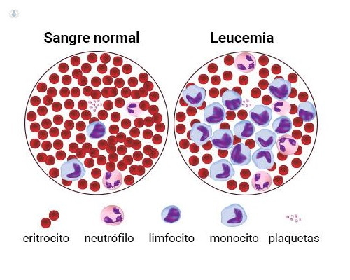 Leucemia: qué es, síntomas y tratamiento | Top Doctors
