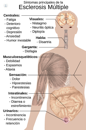 La esclerosis múltiple (EM) es una enfermedad autoinmunitaria que afecta al cerebro y a la médula espinal