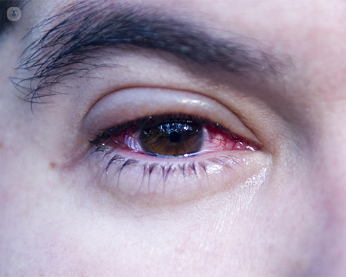 Dolor de párpados y ojos llorosos ¿Es blefaritis?