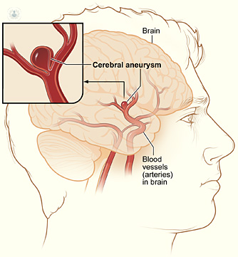 Aneurisma cerebral: qué es, síntomas y tratamiento | Top Doctors
