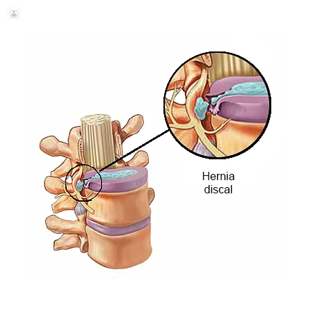 Cirugía percutánea hernia discal: qué es, síntomas y tratamiento | Top  Doctors