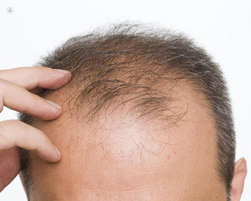 El tratamiento ideal para la alopecia | Top Doctors