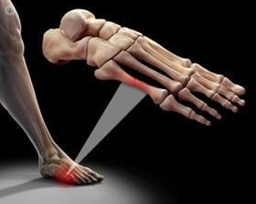 Cómo se produce la fractura del 5º metatarsiano del pie?