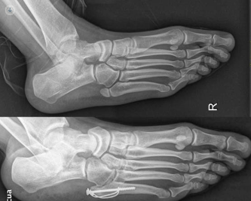 Cómo se produce la fractura del 5º metatarsiano del pie?