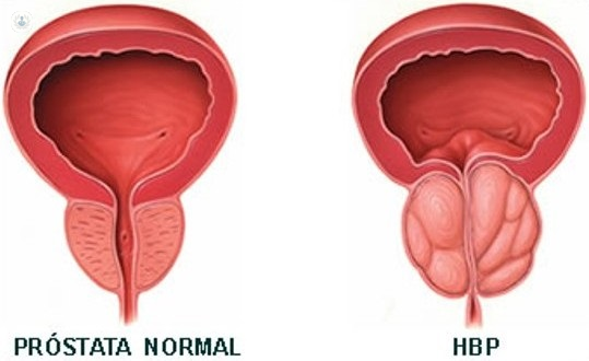 hipertrofia benigna de próstata - Top Doctors