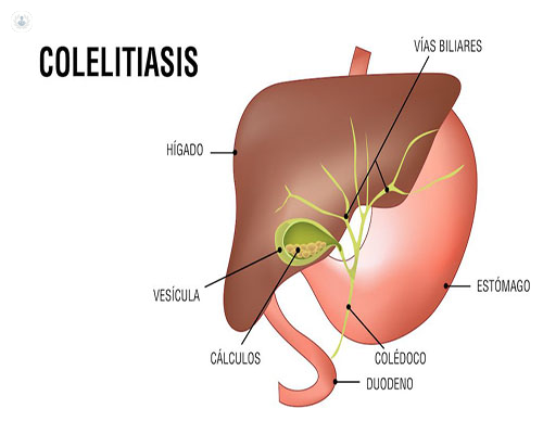 Colelitiasis: qué es, síntomas y tratamiento | Top Doctors
