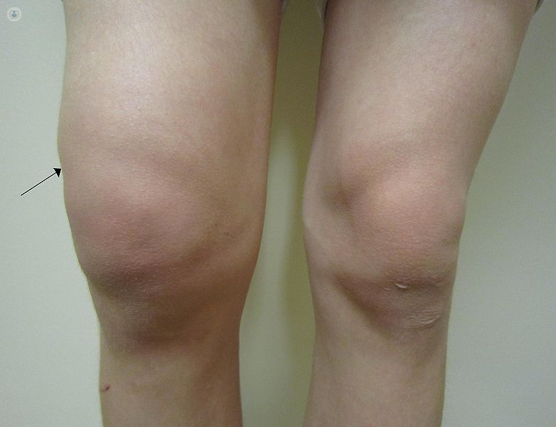 Artrosis de rodilla: qué es, síntomas y tratamiento | Top Doctors