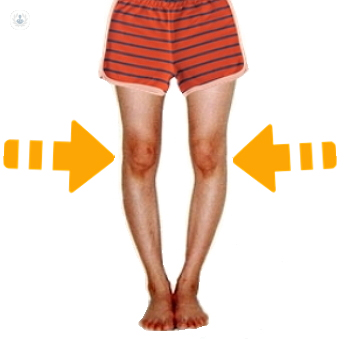 Corrección genu varo (piernas arqueadas): qué es, síntomas y tratamiento |  Top Doctors