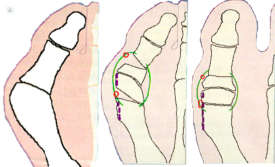 Cirugía percutánea del pie | Top Doctors