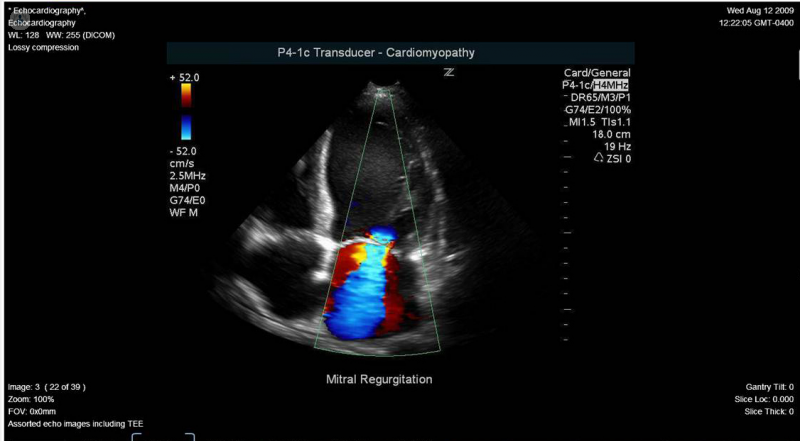 La ecocardiografía doppler color no emite radiación