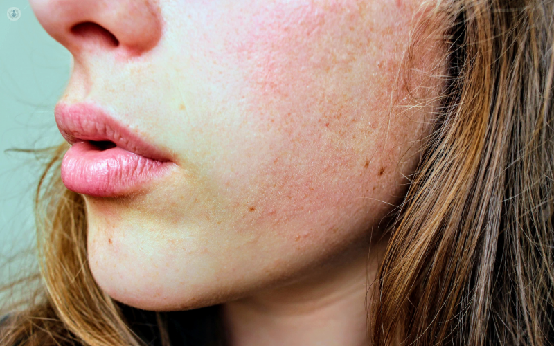 Qué causa el rash en la piel? | Top Doctors