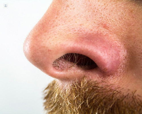 Perforación de tabique nasal: qué es, síntomas y tratamiento | Top Doctors