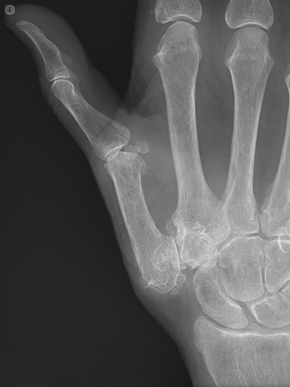 Se puede tratar la artrosis en las manos? | Top Doctors