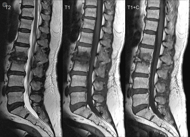 Resonancia magnética de columna: qué es, síntomas y tratamiento | Top  Doctors