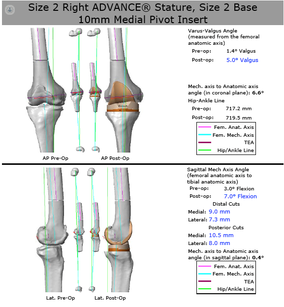 Prótesis de rodilla pre-navegada