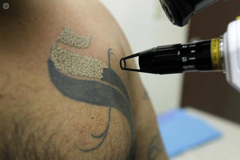 Cómo eliminar tatuajes mediante técnicas láser | Top Doctors