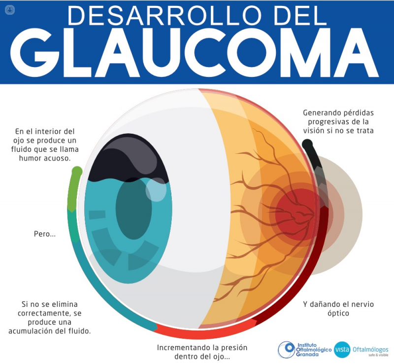¿por Qué Es Importante Detectar El Glaucoma Top Doctorsemk 0102