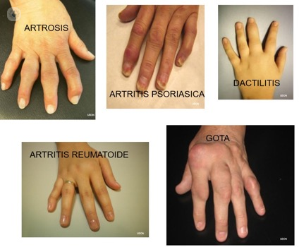 Preguntas Frecuentes, Artrosis de mano y dedo