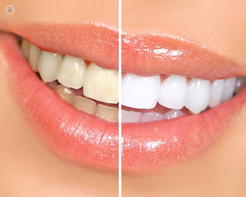 Cómo recuperar el blanco de los dientes?