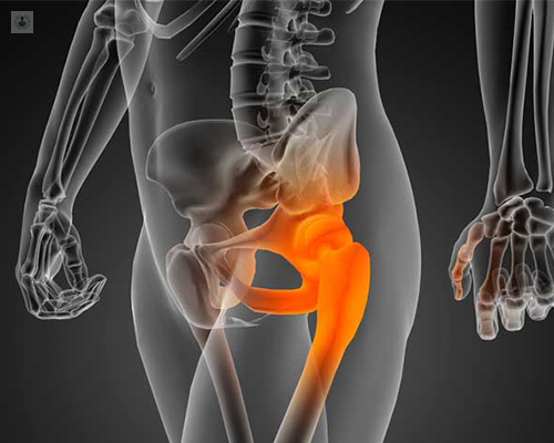 Qué causa el dolor de cadera? | Top Doctors
