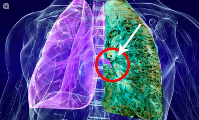 Fibrosis pulmonar: qué es, síntomas y tratamiento | Top Doctors