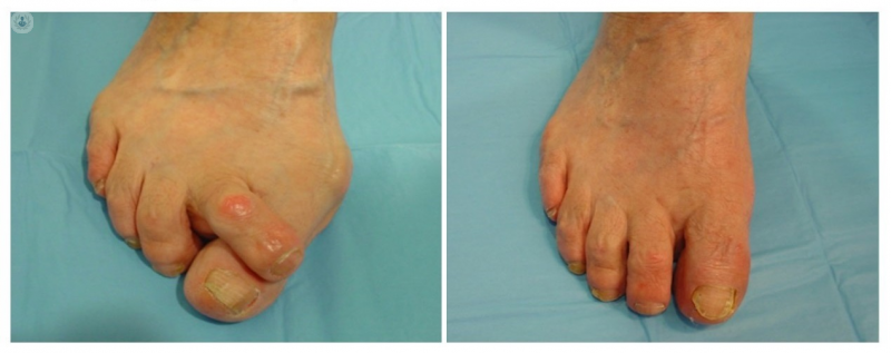 Cirugía mínimamente invasiva para deformidades del pie | Top Doctors