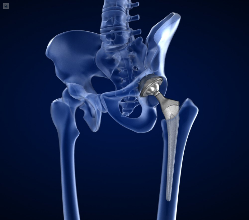 CMI de prótesis de cadera | Top Doctors