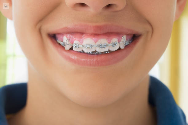 Ortodoncia: una sonrisa bonita mejora la confianza | Top Doctors