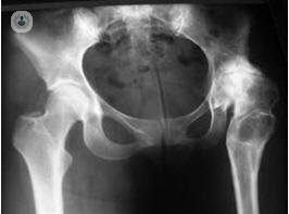 Duración de la prótesis de cadera en el paciente joven