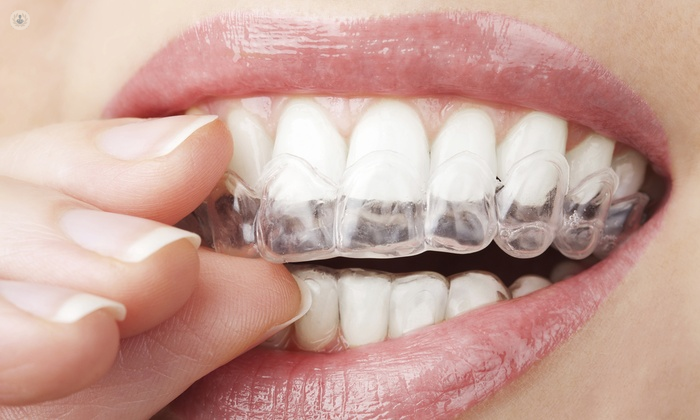 Qué es una férula dental? | Top Doctors
