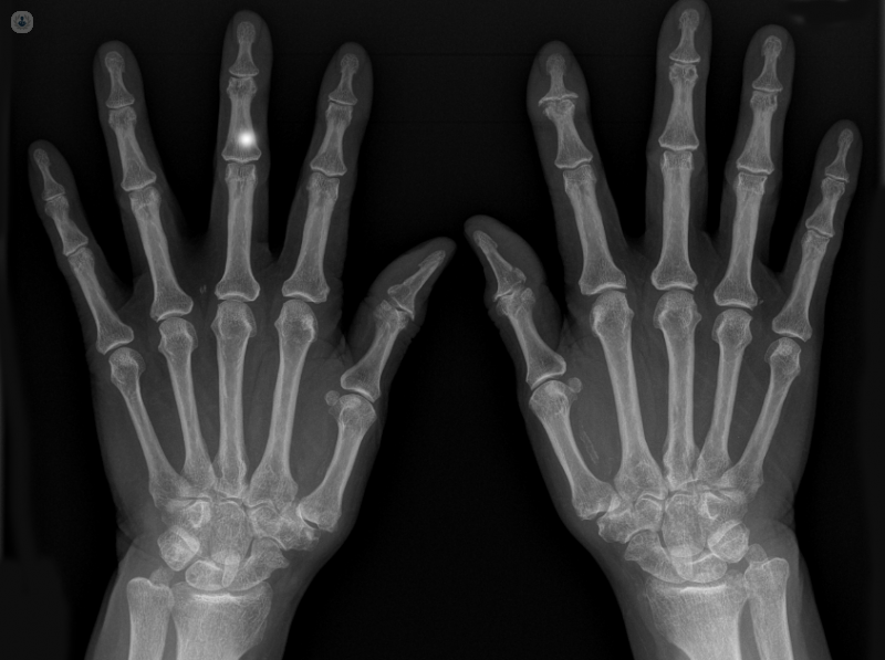 Qué es la artrosis de mano | Top Doctors